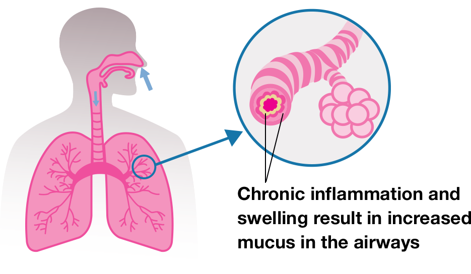 What is COPD? (Chronic Obstructive Pulmonary Disease)